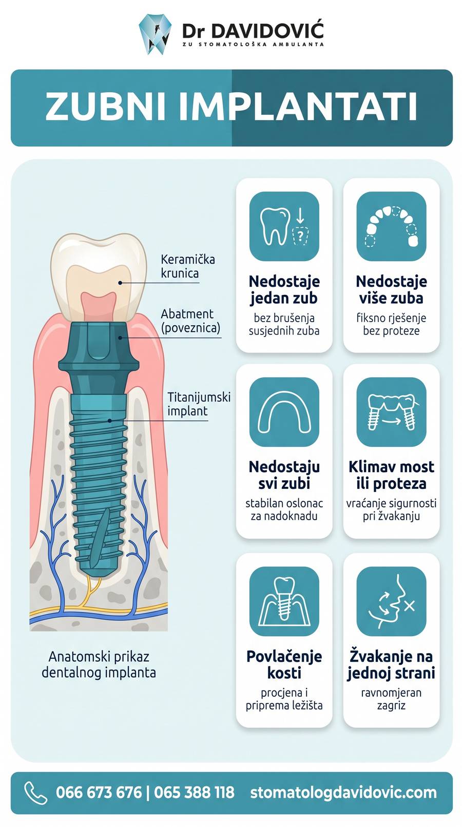 Šest situacija u kojima je zubni implantat pravo rješenje, infografika ordinacije dr Nenada Davidovića u Banjoj Luci