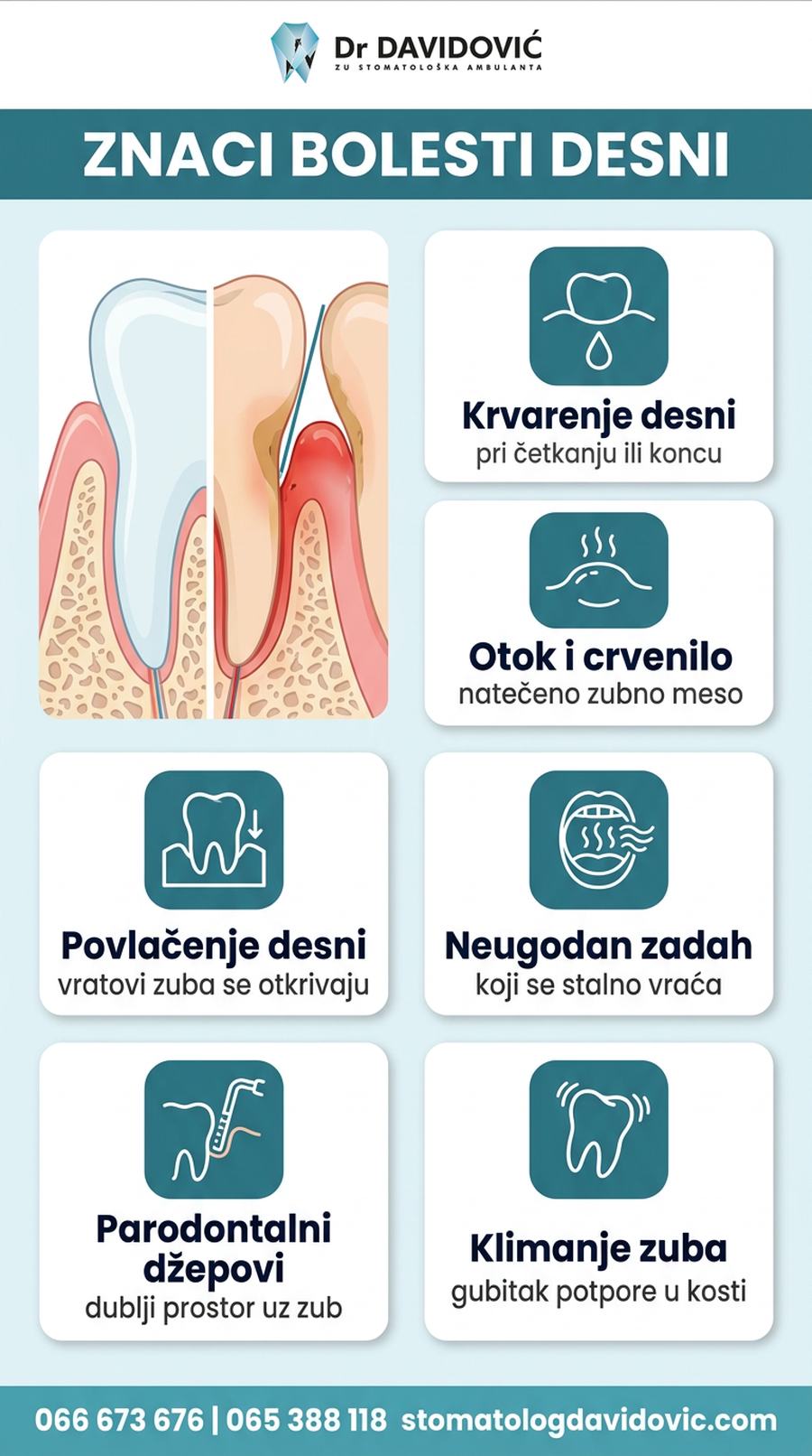 Znaci bolesti desni - krvarenje, otok, povlačenje zubnog mesa i klimanje zuba
