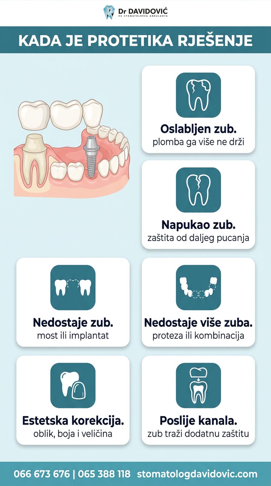 Kada je protetika rje&scaron;enje - oslabljen zub, nedostatak zuba, estetska korekcija