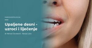 Upaljene desni - uzroci i liječenje, dr Nenad Davidović Banja Luka
