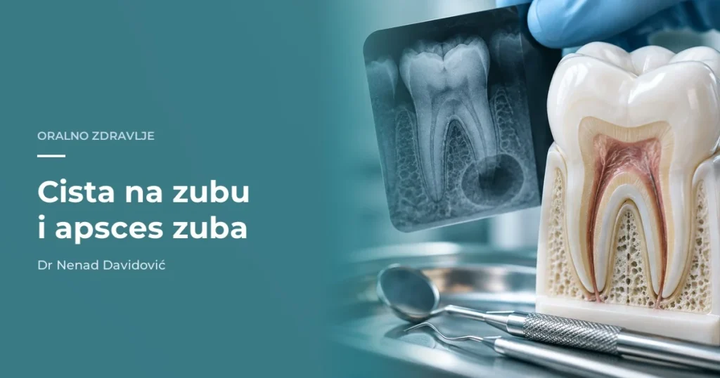 Cista na zubu i apsces zuba - dijagnostika i liječenje kod stomatologa