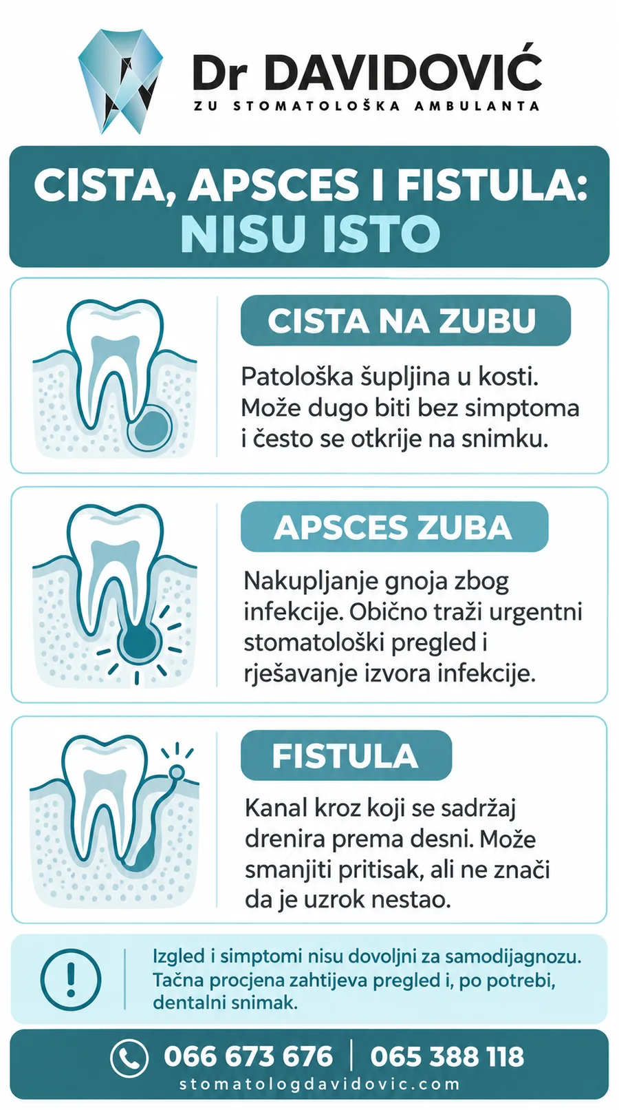 Razlike između ciste na zubu, apscesa zuba i fistule kao pomoć za razumijevanje termina, bez samodijagnoze.